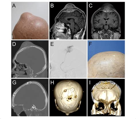 A Clinical Image Of The 8 Cm Scalp Tumor B Sagittal And C
