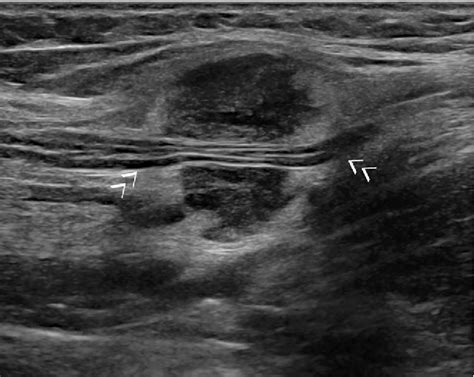 A Bump What To Do Next Ultrasound Imaging Of Superficial Soft Tissue