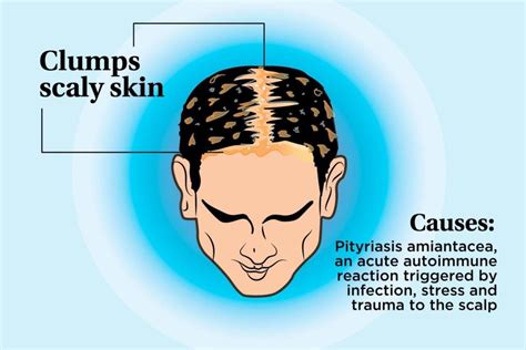 Scalp Conditions You Definitely Dont Want To Ignore The Healthy