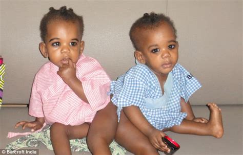 Conjoined Baby Twins From Nigeria Successfully Separated After