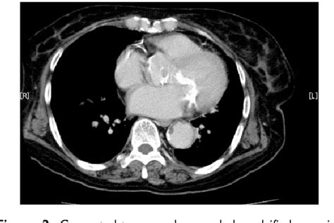 Figure 2 From Cardiac Calcified Amorphous Tumor In A Hemodialysis