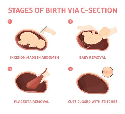 Premium Vector Stages Of Baby Birth Via Cesarean Section Fetus