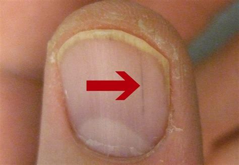 What Causes Red Streaks Under Nails Fingernail Health Nail Health Signs Nail Health