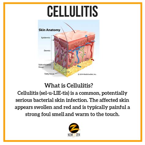 What Is Cellulitis