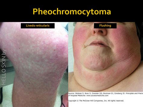 Skin Signs In Pheochromocytoma Hello Skin By หมอผิวหนัง