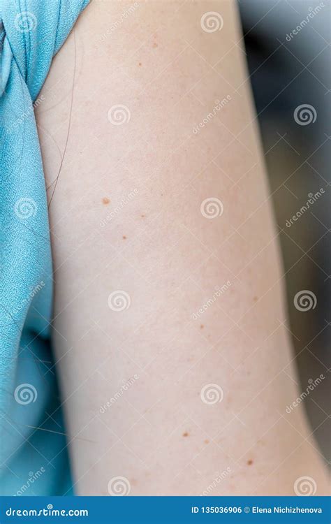 A Birthmark Or A Mole On A Woman Skin Stock Photo Image Of Mark
