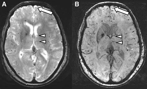 Susceptibility Weighted Imaging Is More Reliable Than T2 Weighted