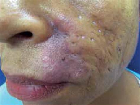 Scielo Brasil Lupus Tumidus A Report Of Two Cases Lupus Tumidus A