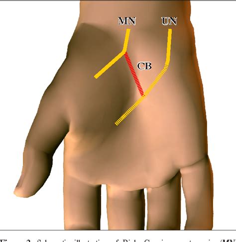 Figure 3 From The Communications Between The Ulnar And Median Nerves In