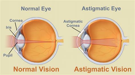 What Is Astigmatism