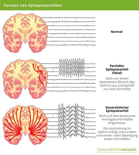 Epilepsie Ursachen Definition Und Behandlung