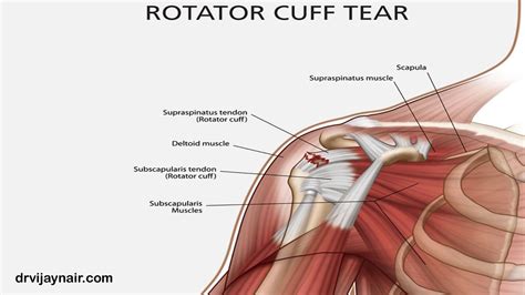 Download gratuito hd o 4k usa tutti i video gratuitamente per i tuoi progetti. Rotator Cuff Injury: Causes, Diagnosis and Treatment ...