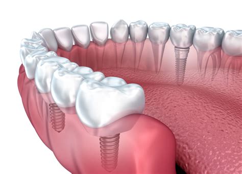 Implant Dentar Corina Dent