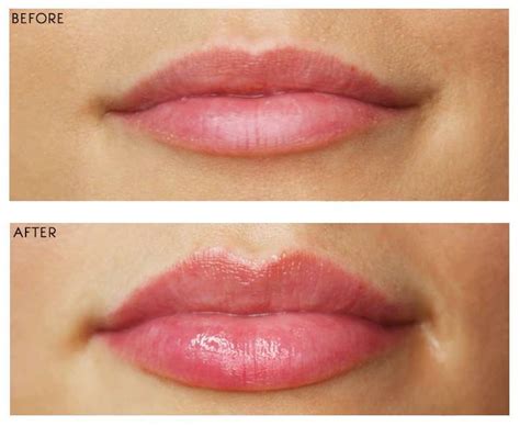 the cupid s bow lip treatment aestha clinic