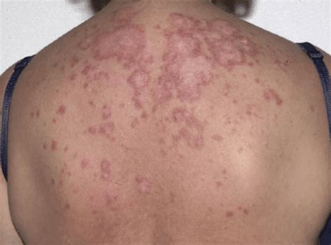What Causes An Autoimmune Rash 10 Possible Conditions 2023