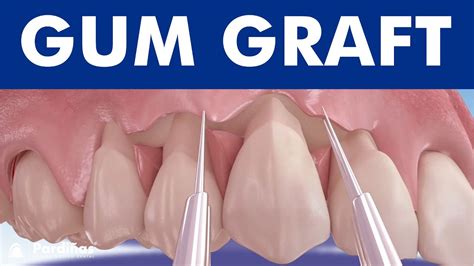 Gum Graft Coronally Advanced Flap Receding Gums Treatment © Youtube