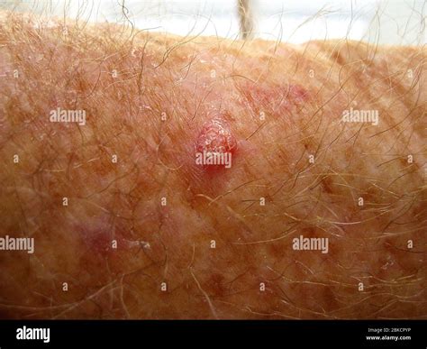 Squamous Cell Cancer High Resolution Stock Photography And Images Alamy