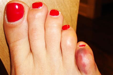 A big list of toe jokes! What Should I Do If I Broke My Pinky Toe? — HealthDigezt.com