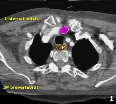 The Radiology Assistant Mediastinal Lymph Node Map