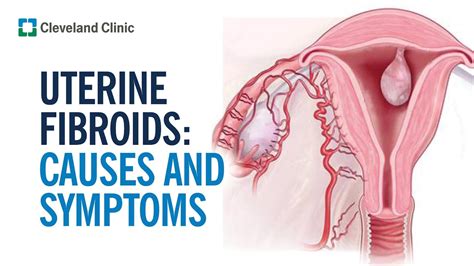 Uterine Fibroids FAQs