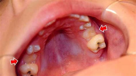 What Are Ankylosed Teeth Ask An