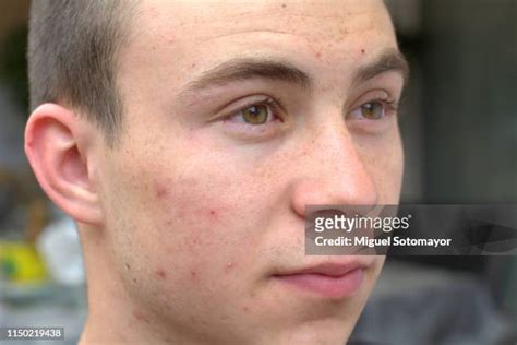 Acne Face Male Photos And Premium High Res Pictures Getty Images