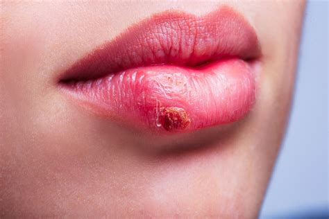 Lippenherpes Symptome Bilder Und Hausmittel