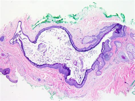 Pathology Outlines Dermoid Cyst