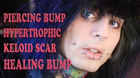 Taking Out Infected Cheek Piercing Keloid Scarhealing Bump Youtube