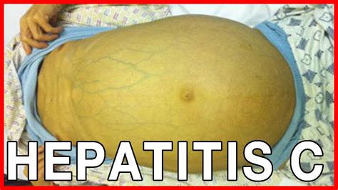 Info About Hepatitis C Symptoms Transmission Hcv And Health Risks