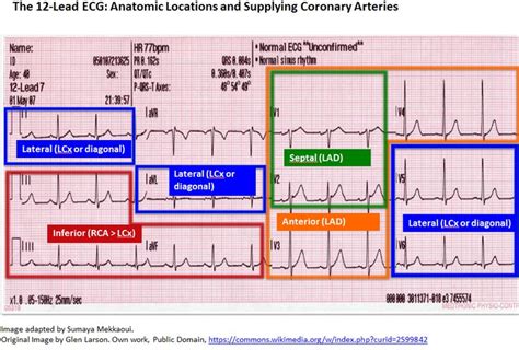 Back To Basics ECG Findings In Acute Myocardial Infarction