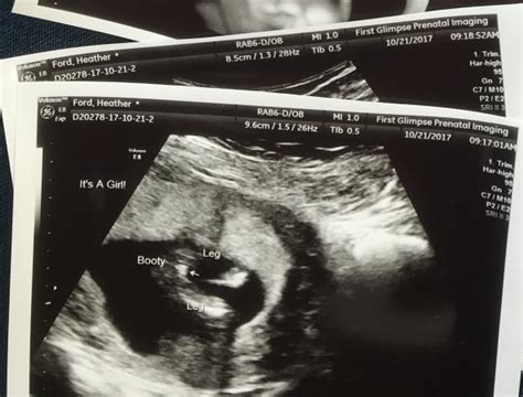 14 Week Gender Ultrasounds Baby And Child