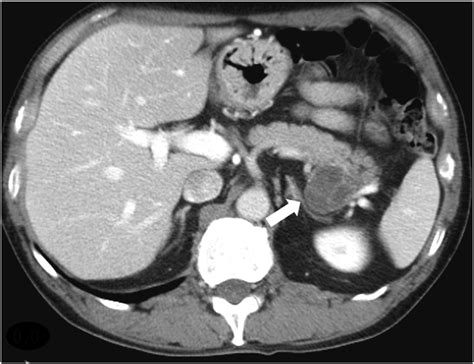 Computed Tomography Ct Enhanced Ct Showed Enhancement Of The Cystic
