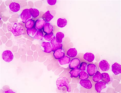 Acute Myeloid Leukemia What Your Patients Need To Know Hematology