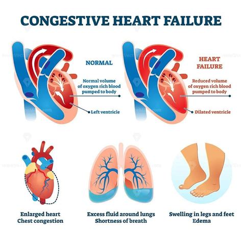 Congestive Heart Failure Clip Art My XXX Hot Girl