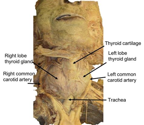 Bilateral Displacement Of The Common Carotid Arteries By A Large Goiter
