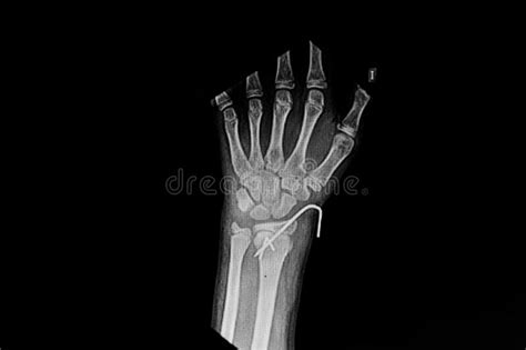 X Ray Wrist Ap That Show Fracture Distal Radius Stock Photo Image Of