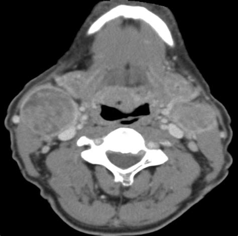 Recurrence And Locoregional Spread Bilateral Cervical Lymphadenopathy