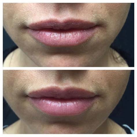 5 Quick Facts On Lip Enhancement With Juvederm Volbella Minuk Laser
