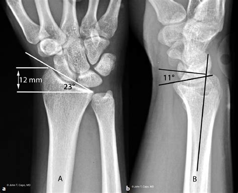 Distal Tibial Fractures Musculoskeletal Key