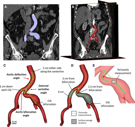Morphology And Hemodynamics In Isolated Common Iliac Artery Aneurysms