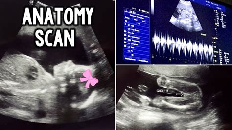 Anatomy Scan Ultrasound