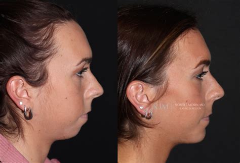 Chin Surgery Photo Gallery Genioplasty Hackensack Nj