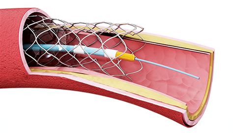 Unveiling The Future Of Peripheral Vascular Devices Trends And
