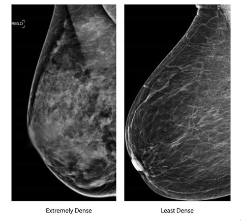 No Clear Answers With Mammograms And Dense Breasts