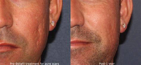 Acne Scars San Diego Ca Cosmetic Laser Dermatology