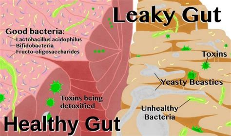 Natural Treatments For Leaky Gut Syndrome