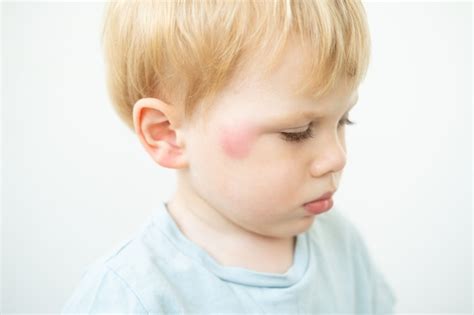 Premium Photo Portrait Of Little Boy With Allergic Red Spot At Face