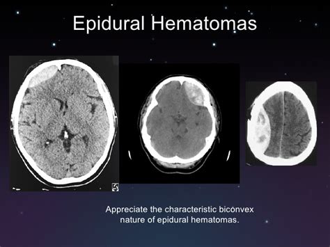 These head injuries involved bleeding that is initially confined headache: Subdural And Epidural Hematoma Ct - maternity photos