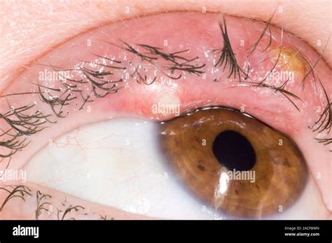 Eye Abscesses On The Upper Eyelid Of A 40 Year Old Woman These Are